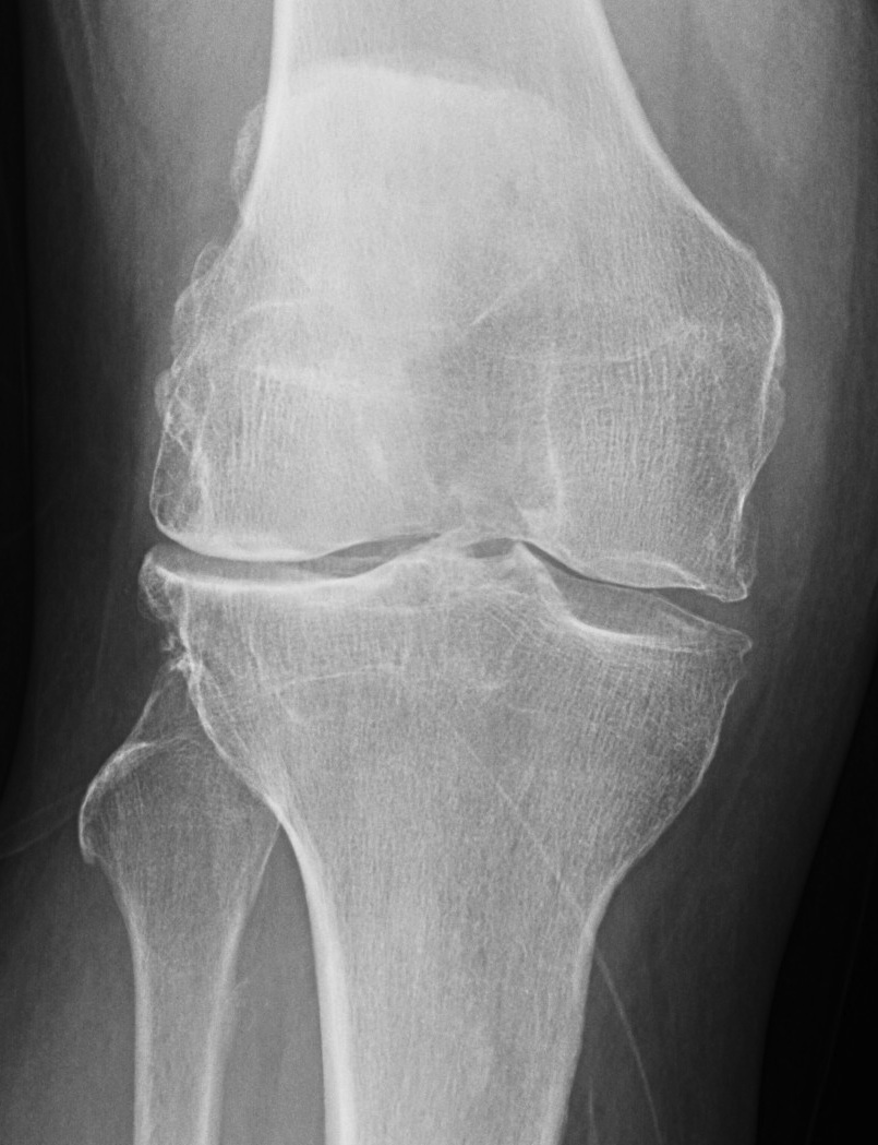 Knee Lateral Compartment OA